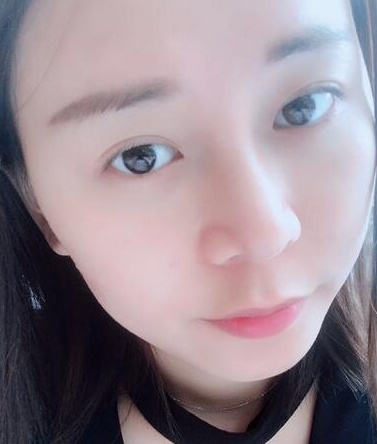 广州做的鼻部手术隆鼻手术案例