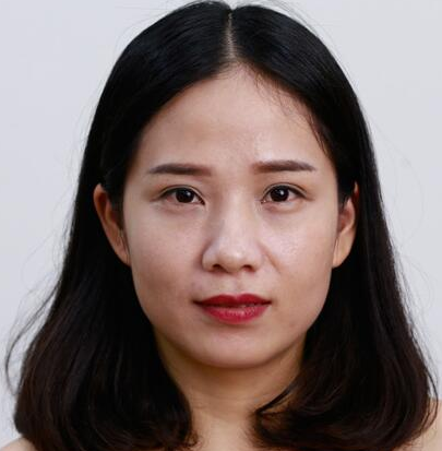 苏州做的双眼皮+开内眼角手术案例