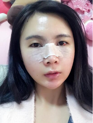 上海自体脂肪填充全脸+鼻部手术的案例