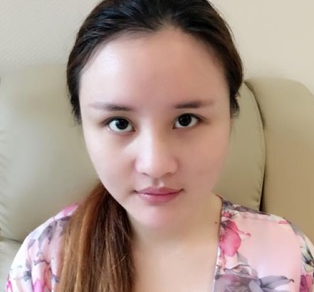 武汉半肋鼻部手术+眼部手术+自体脂肪填充手术案例