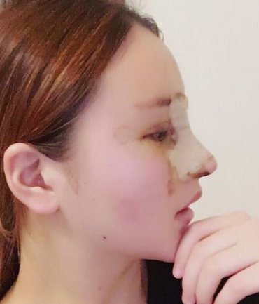 武汉半肋鼻部手术+眼部手术+自体脂肪填充手术案例