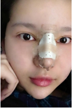 广州做的鼻部手术隆鼻手术案例