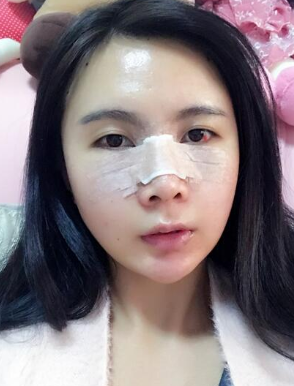 上海自体脂肪填充全脸+鼻部手术手术案例