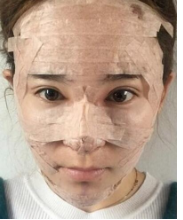 廊坊面部脂肪填充+鼻部手术手术案例