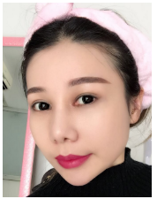 武汉做的眼部手术+鼻部手术+祛眼袋手术案例