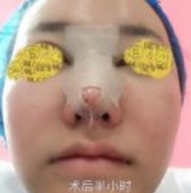 去上海找专家做的鼻部手术手术案例