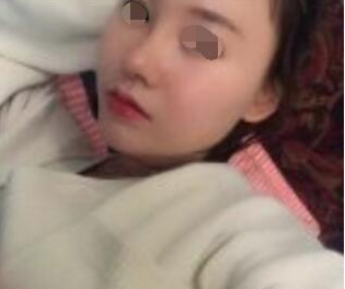 去上海找专家做的鼻部手术手术案例