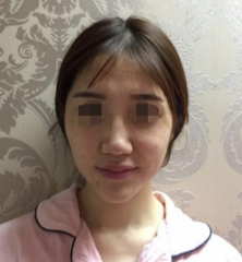 北京鼻部手术和自体脂肪填充日记分享