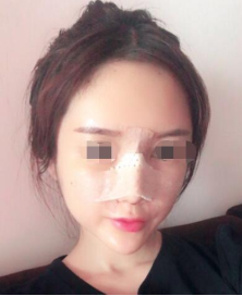 北京鼻部手术和自体脂肪填充日记分享