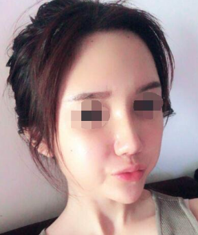 北京鼻部手术和自体脂肪填充日记分享