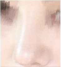 上海半肋软骨鼻部手术修复分享！