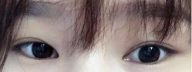 3月在广州曙光做的眼部手术：双眼皮开眼角还有提