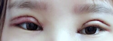 3月在广州曙光做的眼部手术：双眼皮开眼角还有提
