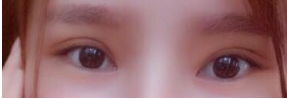 3月在广州曙光做的眼部手术：双眼皮开眼角还有提