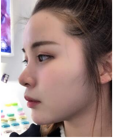 在八大处做的鼻部手术，来分享我的果咯~