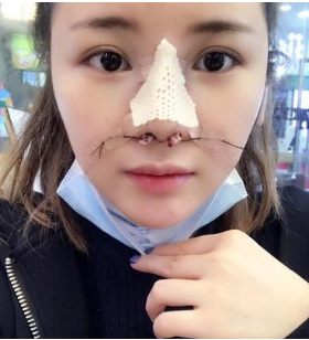在八大处做的鼻部手术，来分享我的果咯~