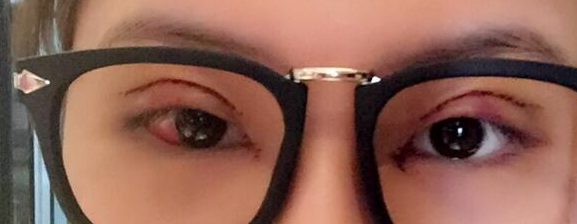上海全切双眼皮开眼角日记分享!