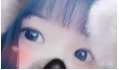 重庆医科大学附属第一医院割双眼皮日记!