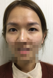 上海全切双眼皮日记分享!