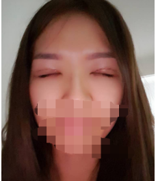 上海全切双眼皮日记分享!