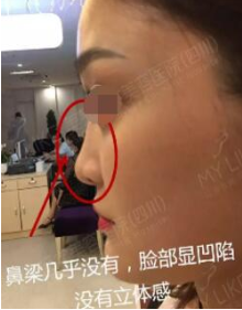 成都假体隆鼻修复一个月果