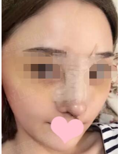 成都假体隆鼻修复一个月果