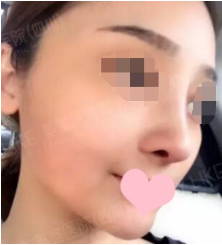 成都假体隆鼻修复一个月果