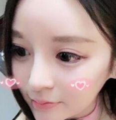 重庆隆鼻部手术案例日记