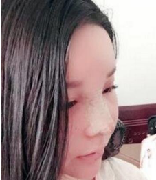 重庆隆鼻部手术案例日记