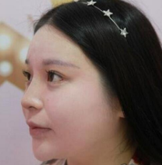 重庆隆鼻部手术案例日记
