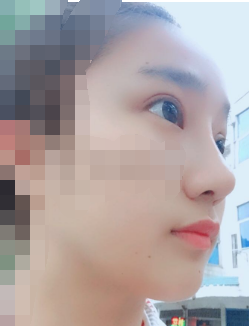 杭州双眼皮开眼角和鼻部手术手术一个月啦~