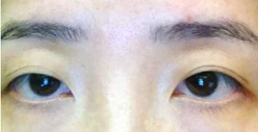 几年前在上海九院做的双眼皮修复,8mm的大眼睛