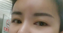 北京全脸自体脂肪填充案例日记分享!