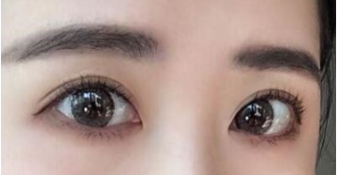 几年前在上海九院做的双眼皮修复,8mm的大眼睛