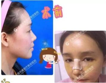 上海华美做了隆鼻部手术和脂肪填充手术案例