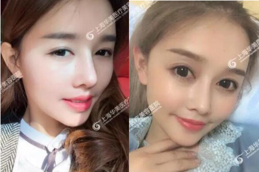 上海华美做了隆鼻部手术和脂肪填充手术案例