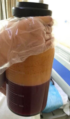 长沙吸脂哪里好?来看我的大腿吸脂分享