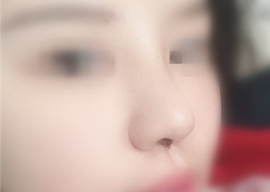 太原刚做了鼻部手术修复,一周待消肿