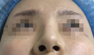 杭州格莱美肋软骨隆鼻部手术修复案例分享