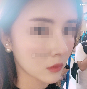 杭州格莱美肋软骨隆鼻部手术修复案例分享