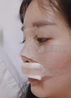 南京华美鼻部手术术后两个月,案例分享