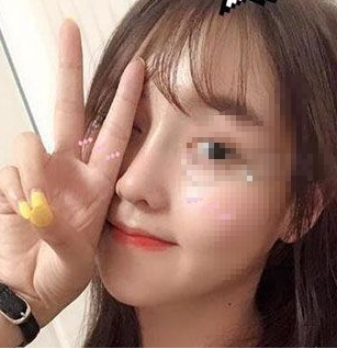 南京华美鼻部手术术后两个月,案例分享