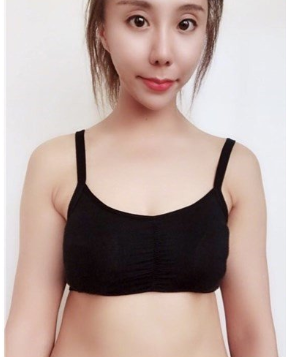 北京做的自体脂肪隆胸+胸部提升+大腿吸脂,果