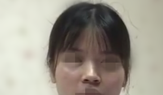 上海时光郑志玉做的鼻部手术二十多天案例分享