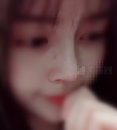 上海时光郑志玉做的鼻部手术二十多天案例分享