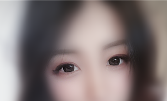 南京做的全切眼部手术(双眼皮+开内外眼角+眼睑下