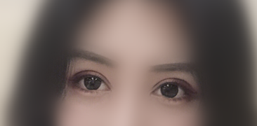 南京做的全切眼部手术(双眼皮+开内外眼角+眼睑下