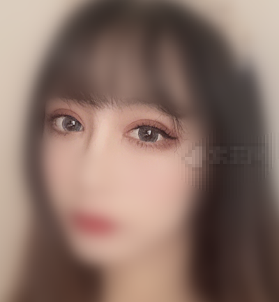 南京做的全切眼部手术(双眼皮+开内外眼角+眼睑下