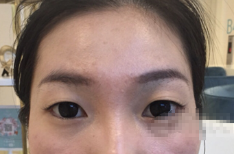 成都华颜全切双眼皮,平扇型,三个月啦