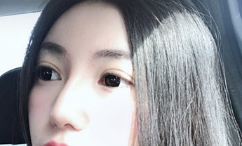 成都华颜全切双眼皮,平扇型,三个月啦